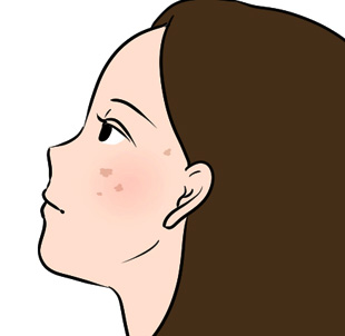 シミに悩む女性